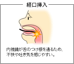 経口挿入