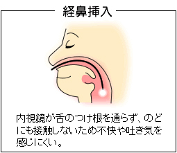 経鼻挿入